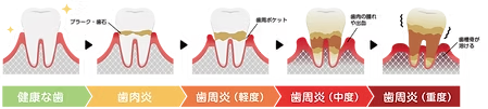歯周病の治療